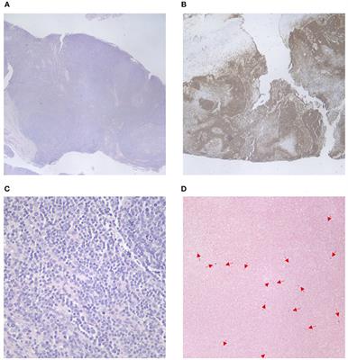 Evaluation of Lymphoproliferative Disease and Increased Risk of Lymphoma in Activated Phosphoinositide 3 Kinase Delta Syndrome: A Case Report With Discussion